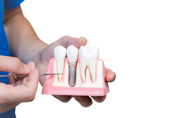 Dental Implants Springfield, IL