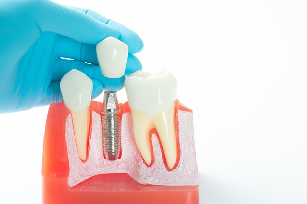 How Dental Implants Slow Down And Prevent Bone Loss