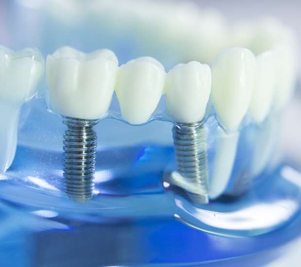 Springfield Dental Implants