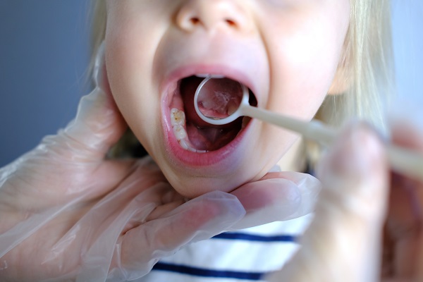Types Of Dental Fillings For Kids Offered By A Kid Friendly Dentist In Springfield