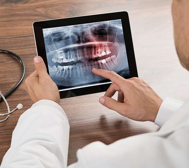 Springfield Types of Dental Root Fractures